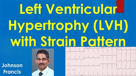 lv strain pattern|lvh with strain pattern meaning.